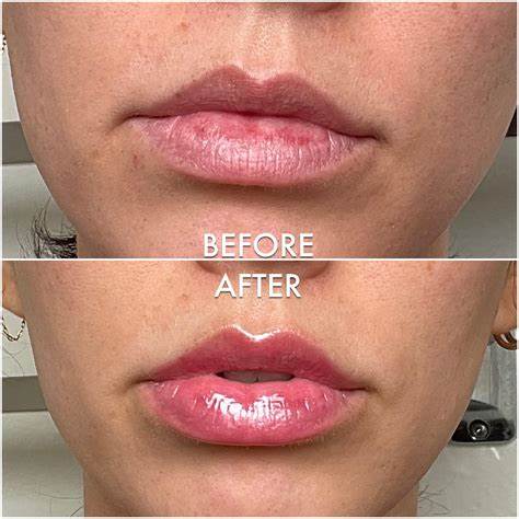 LIP MAXIMIZER - Gloss Voluminizador de Labios